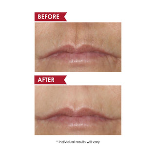 SMOOTH UPPER LIP PROFESSIONAL Perioral Anti-Aging Treatment